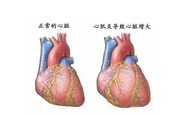 肌炎是难治之症吗(特发性炎症性肌炎能治愈吗)图1