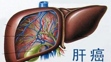 家人得了肝癌晚期怎么办图1